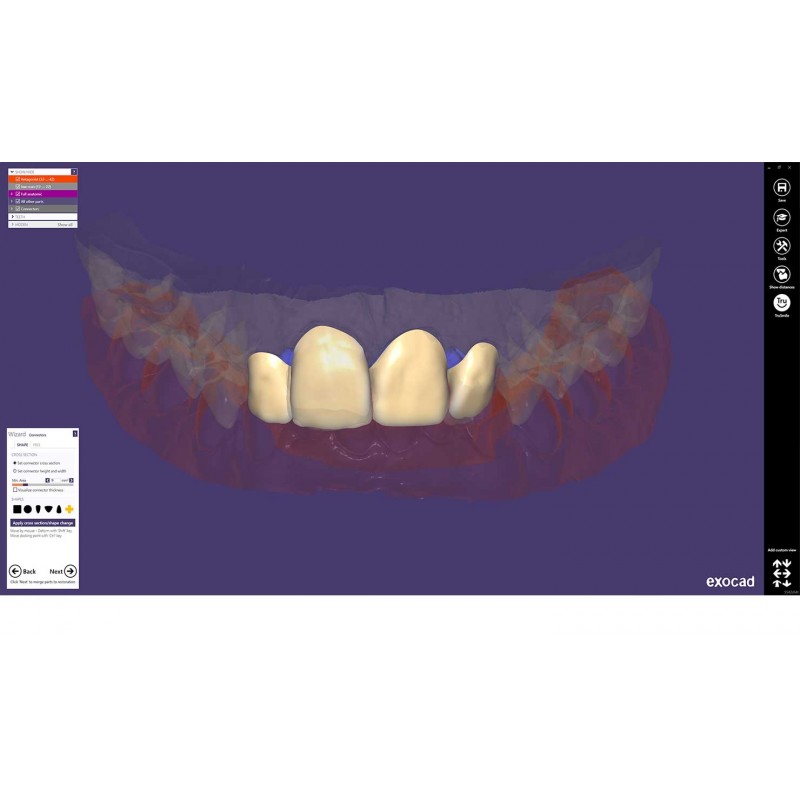 Modul exocad Provisional