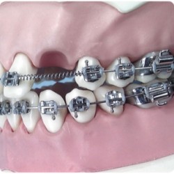 Arc deschis Coil Spring pt extraoral .045/010 lip bumper 2 buc.