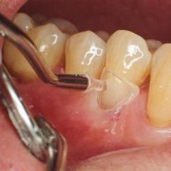 LM Cervical Matrices for canines/premolars