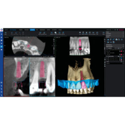 Romexis 3D Implant