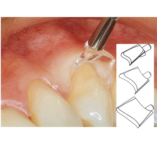 Gingival retractor, XL (60db)fogíny visszahúzó őrlőkhöz