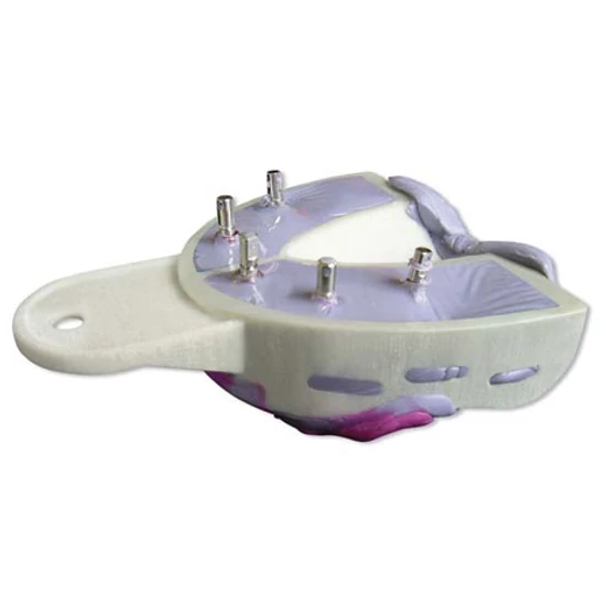 Miratray Implant  felső OK S1 small  6db