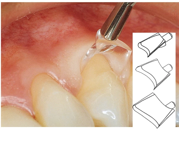 Gingival retractor, XL (60db)fogíny visszahúzó őrlőkhöz